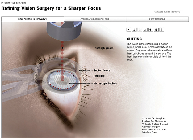 Lasik